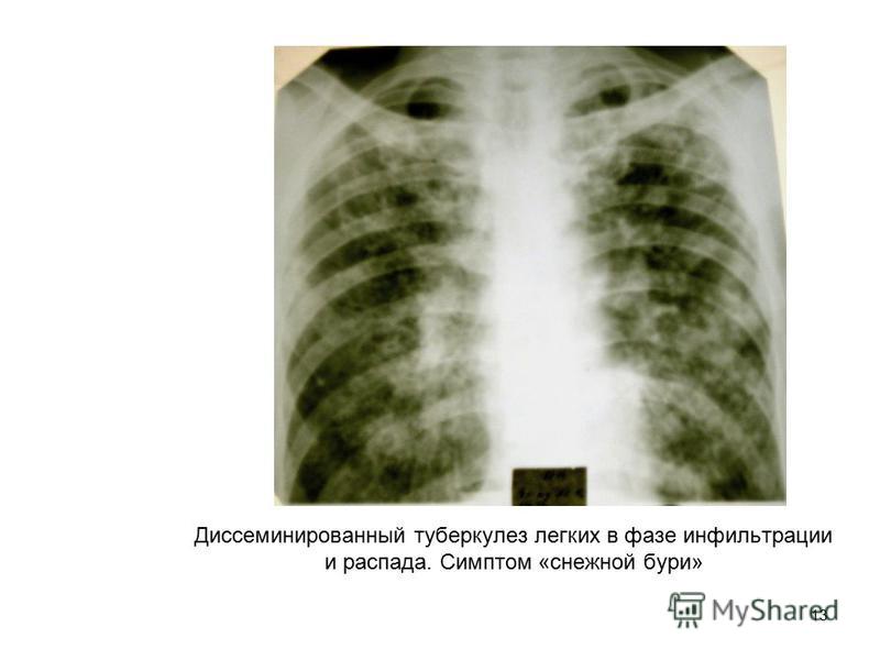 Распад легкого. Подострый диссиминированный туберкулёз рентген. Диссеминированный инфильтративный туберкулез. Острый диссеминированный туберкулез рентген. Подострый диссеминированный туберкулез рентген.