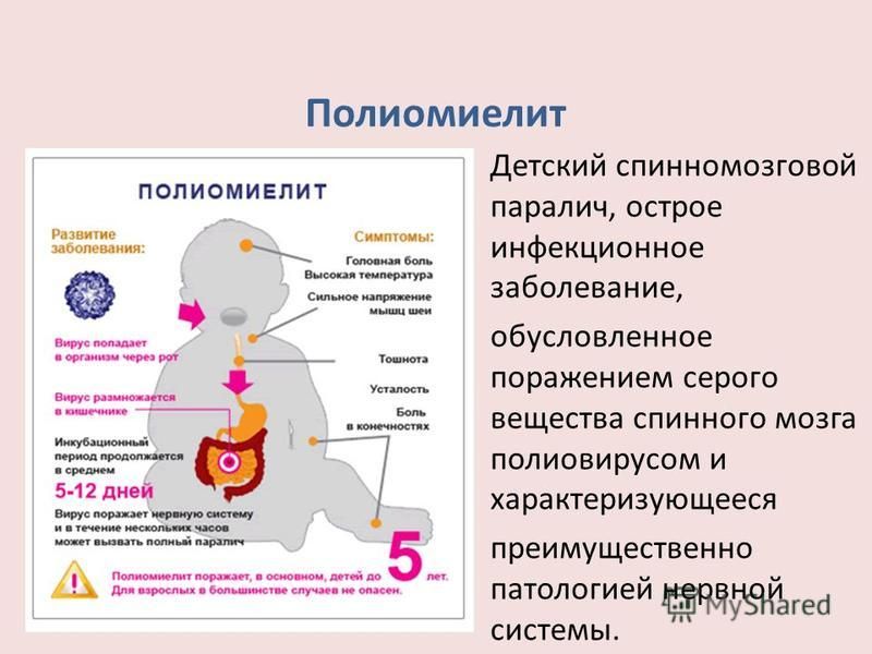 Инфекционное заболевание полиомиелит. Острый паралитический полиомиелит. Вирус полиомиелита профилактика. Клинические симптомы полиомиелита. Инаппарантная форма полиомиелита.