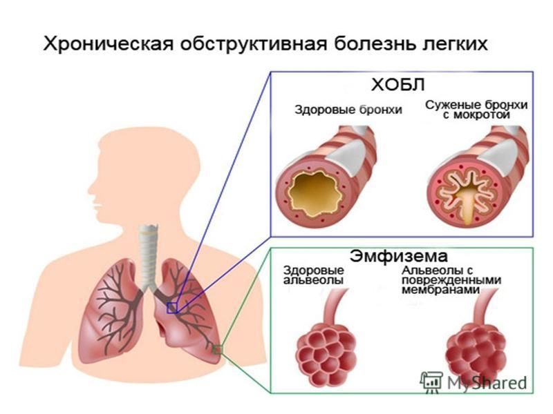 Хронический бронхит и астма. Группы инвалидности при бронхиальной астме. Обструктивная болезнь лёгких. Хроническая обструктивная болезнь лёгких.