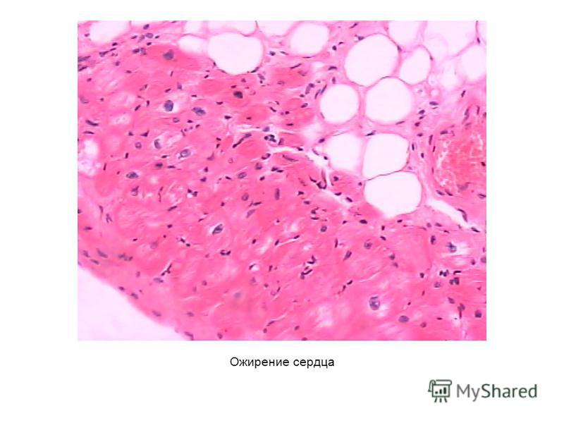 Жировая дистрофия миокарда