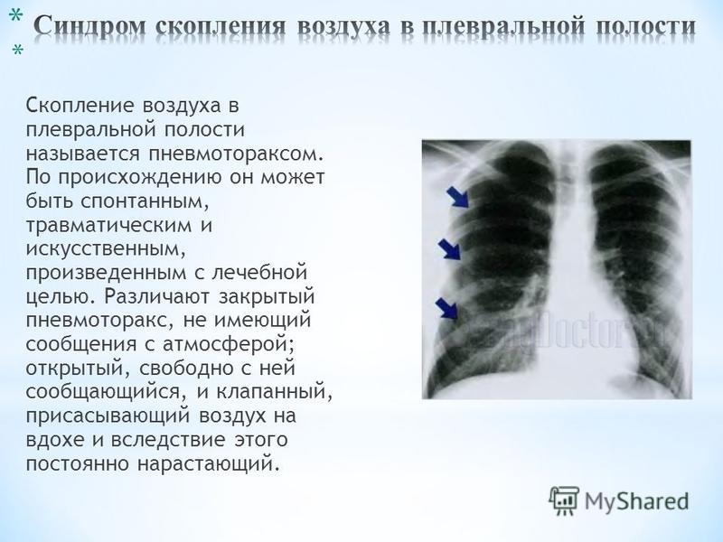 Скопление в плевральной полости. Скопление воздуха в плевральной полости рентген. Синдром скопления воздуха в плевре. Синдром скопления воздуха в плевральной. Синдром воздуха в плевральной полости.