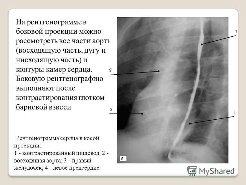 Рентгенограмма в боковой проекции