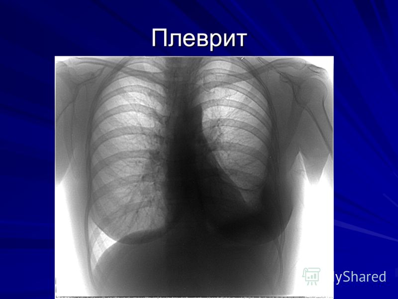 Плеврит что это. Сухой плеврит рентген. Односторонний плеврит.