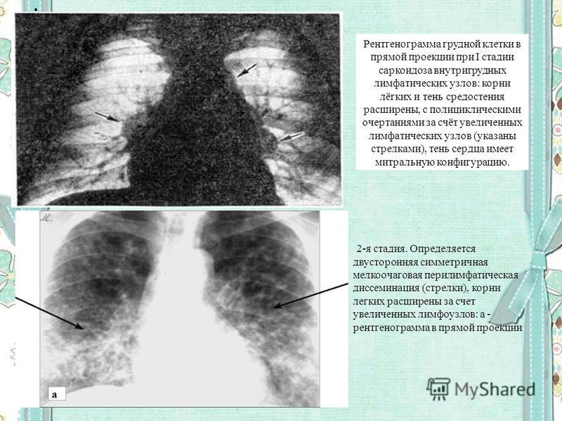Увеличение лимфоузлов в легких причины. Саркоидоз лёгких рентгенописание. Саркоидоз лёгких формы рентген. Саркоидоз диссеминация. Саркоидоз рентгенологическая картина.