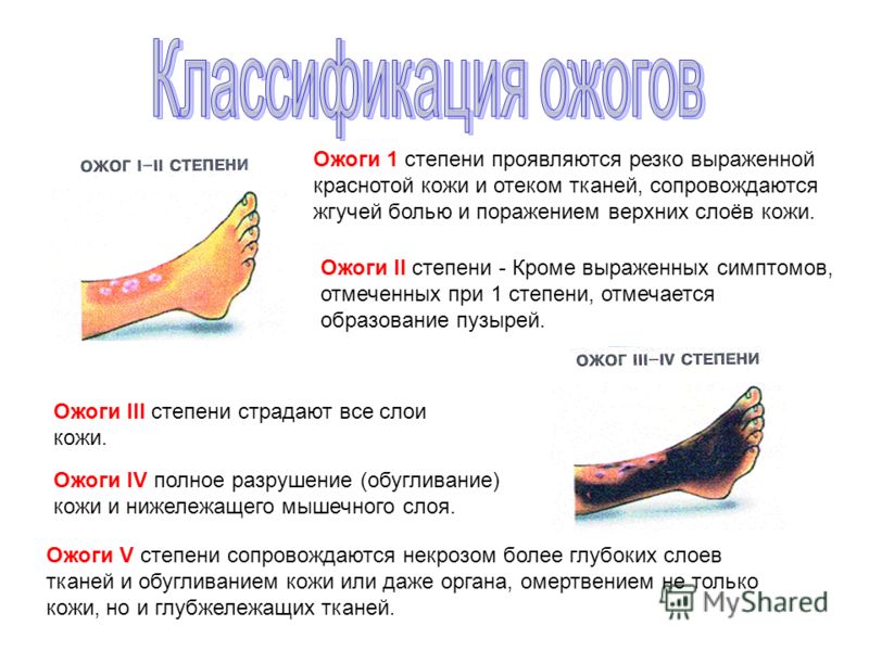 При ожоге третьей степени необходимо