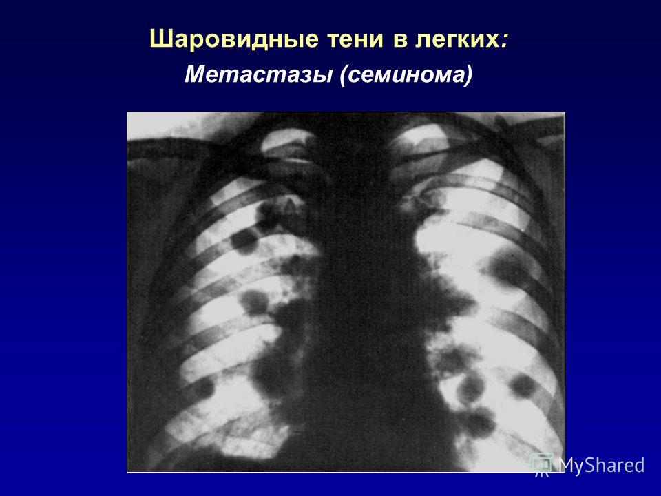 Метастазы в легких это. Шаровидные образования в легких. Мелкоочаговые метастазы в легких. Снимки метастаз в легких.