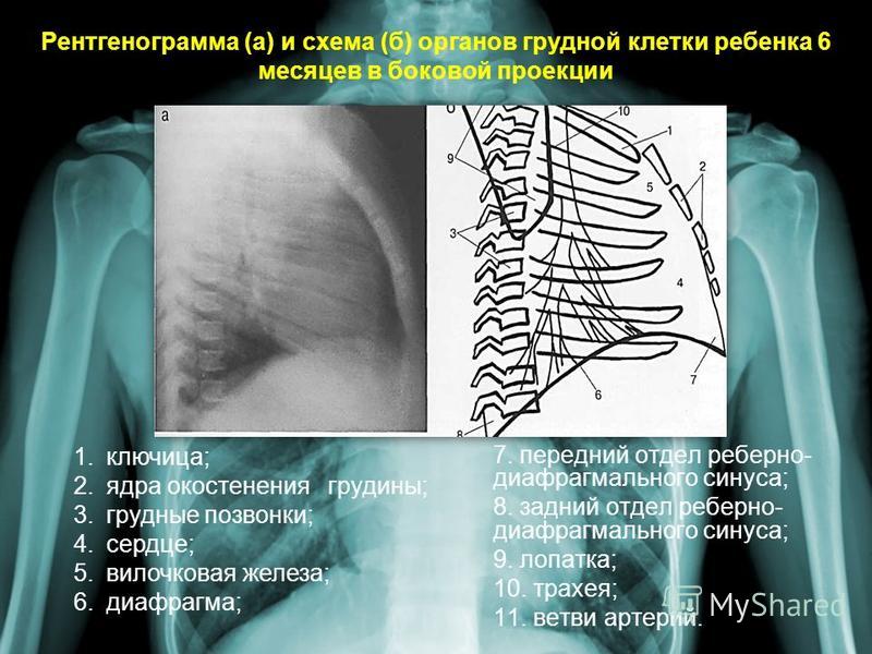 Рентгенограмма в боковой проекции. Рентгенография боковая проекция. Боковая проекция легких на рентгене. Боковая рентгенограмма органов грудной клетки.