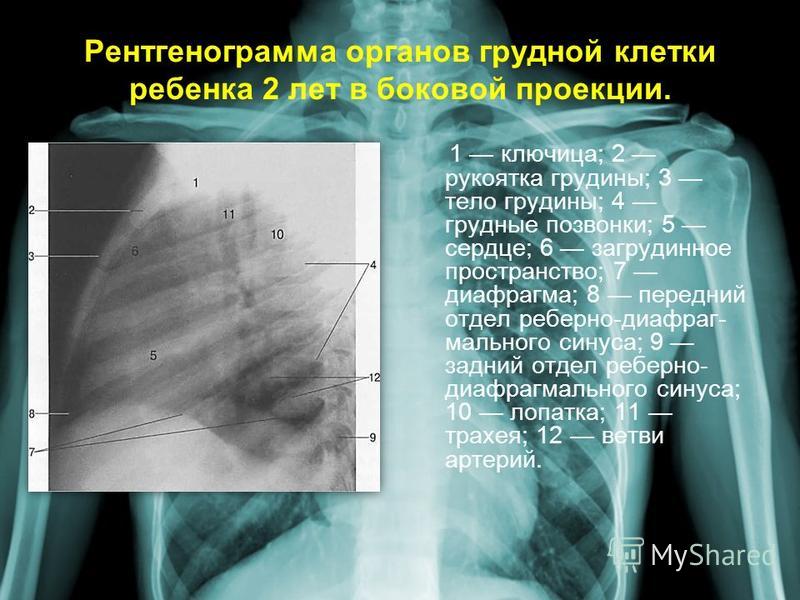 Рентгенограмма в боковой проекции