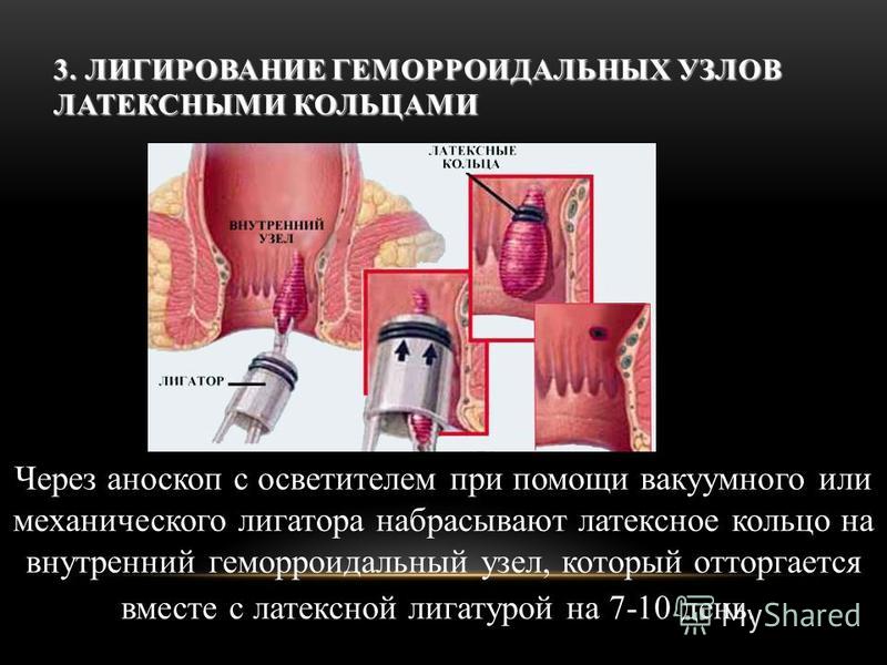 Легирования латексными кольцами