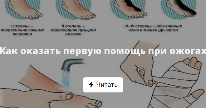 Ожог кипятком первая помощь дома