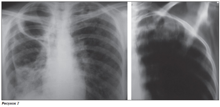Исчезающее легкое. Симптом исчезающего легкого. Штампованные каверны при туберкулезе рентген. Каверна в медицине на рентгене.