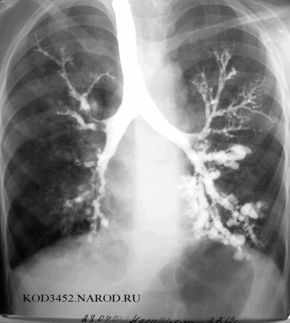 Болезнь рентген. Бронхоэктатическая болезнь бронхография. Бронхоэктазы рентген бронхография. Бронхоэктатическая болезнь рентгенография. Рентгенограмма при бронхоэктатической болезни.