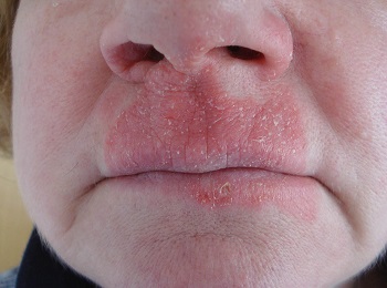 Аллергический контактный дерматит вокруг носа и рта