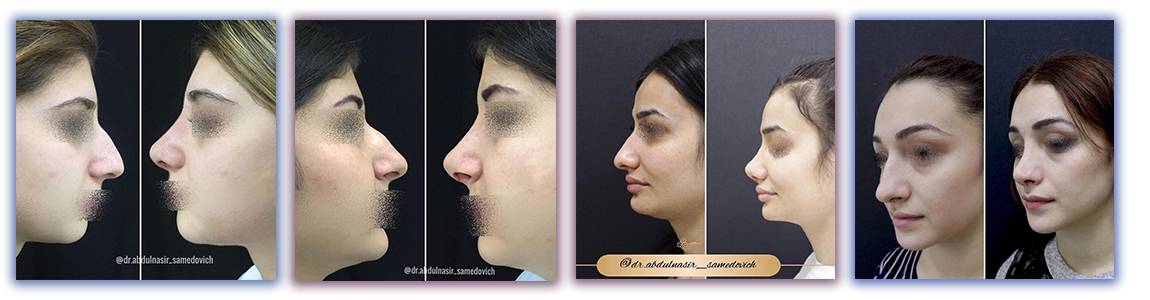 Операция на перегородку носа до и после фото