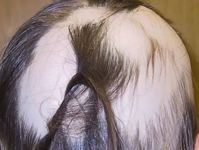 От краски выпадают волосы. Гнездная алопеция тотальная. Очаговая (гнездная) алопеция. Очаговая алопеция (alopecia Areata).