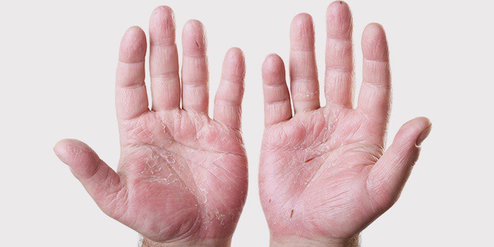 шелушение кожи на ладонях причины лечение и профилактика