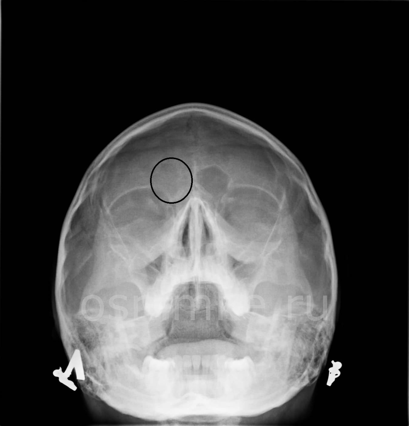 Фронтит лобных пазух. Рентген придаточных пазух фронтит. Рентген лобных пазух фронтит. Рентген пазух носа фронтит. Рентген придаточных пазух носа фронтит.