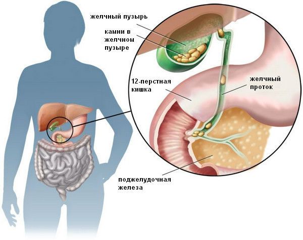 Камни в желчном пузыре