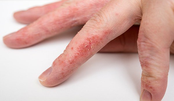 проявление аллергии на пальцах рук