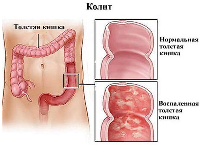 колит что такое