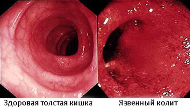 лечение колита