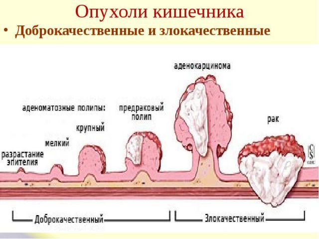 Опухоли кишечника