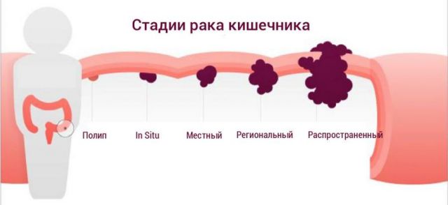 Стадии рака кишечника