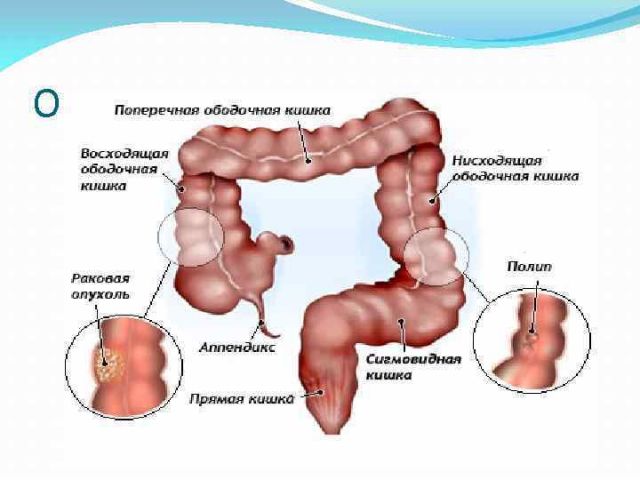 Опухоли кишечника