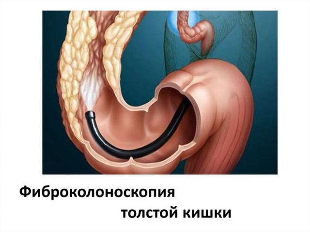 Фиброколоноскопия толстой кишки