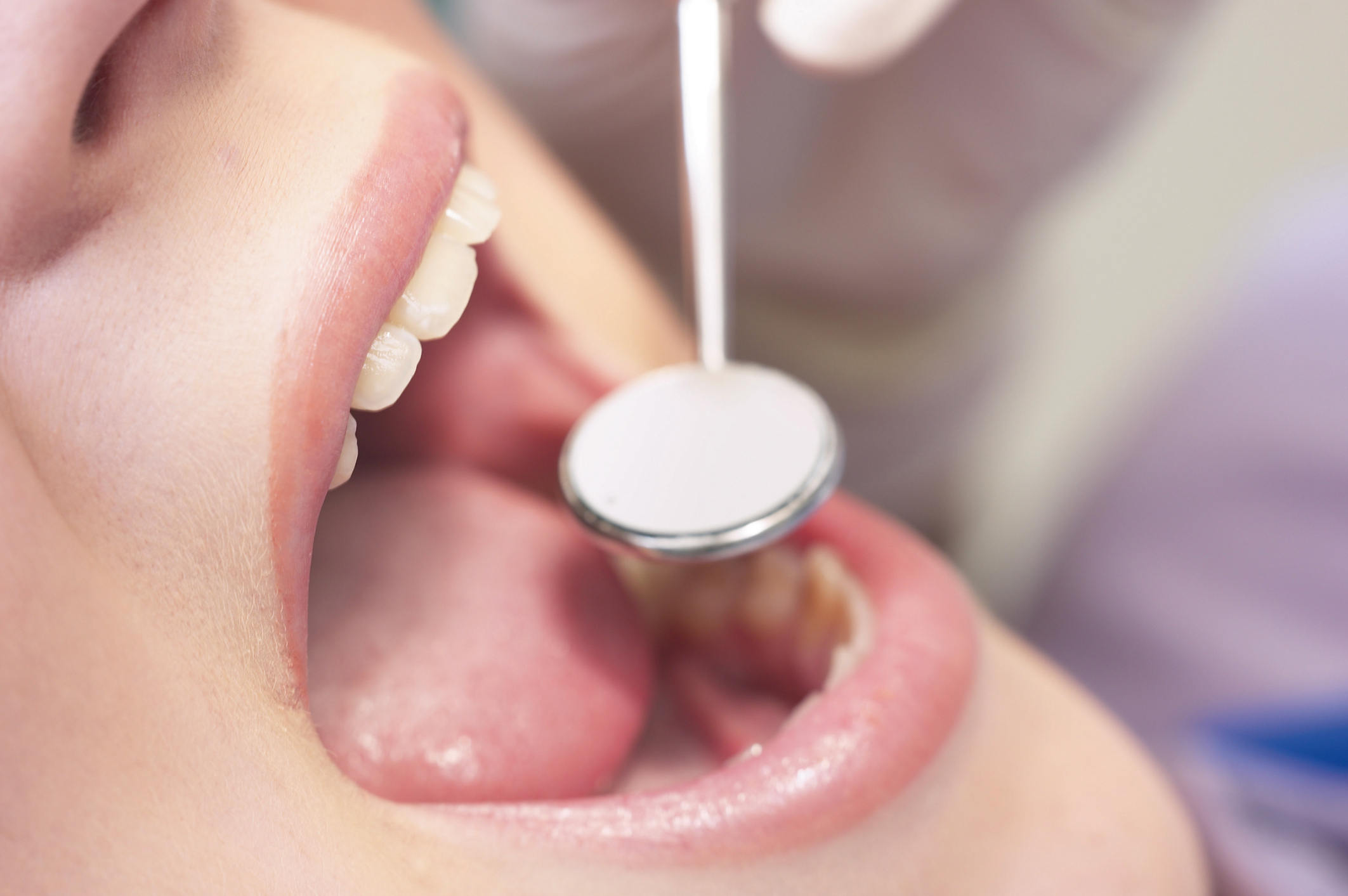 Лечение полости рта и зубов. Осмотр слизистой оболочки полости рта. Папиллома в ротовой полости.