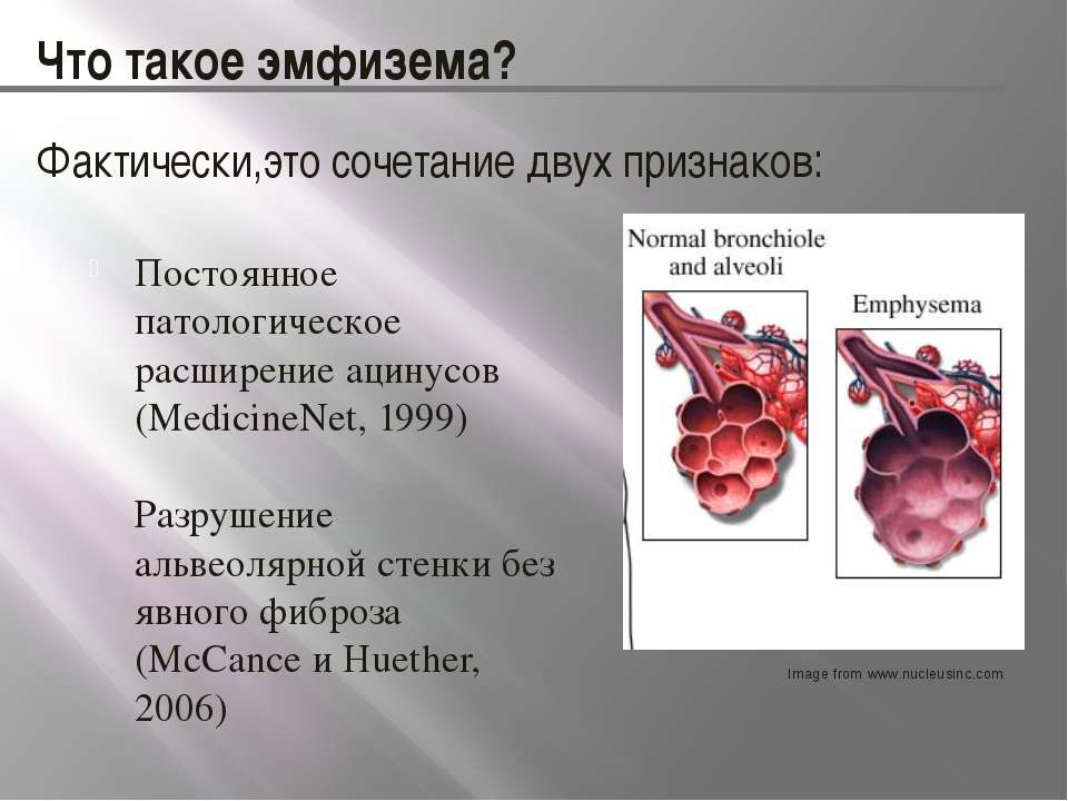 Эмфизема легких это. Альвеолярная эмфизема. Альвеолярная эмфизема легких. Эмфизема легких характеризуется:. Патологическое расширение альвеол.