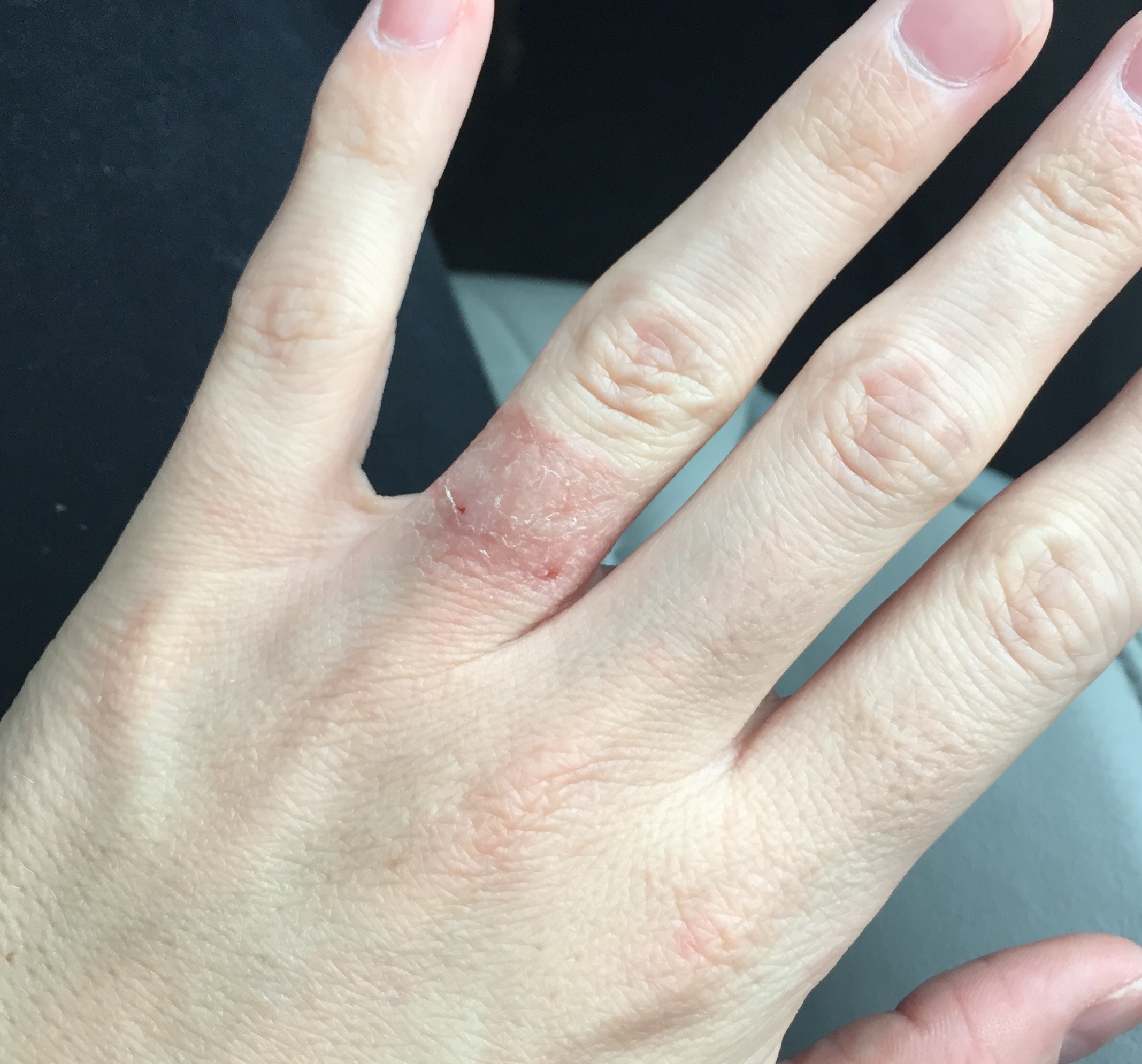 Почему чешутся пальцы на левой руке. Фотодерматит (фотодерматоз). Аллергический дерматит на пальцах.