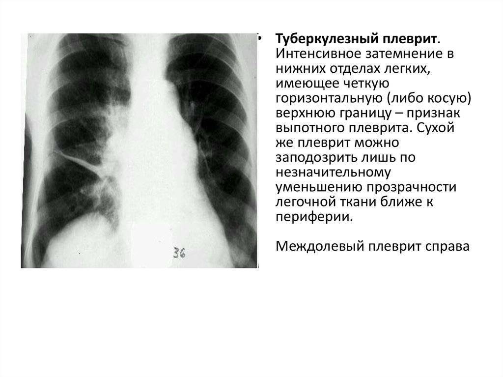 Описание рентгенограммы. Туберкулезный плеврит легких рентгенограмма. Туберкулезный плеврит легких рентген. Описание рентгенограммы при пневмонии. Туберкулезный плеврит рентгенограмма.