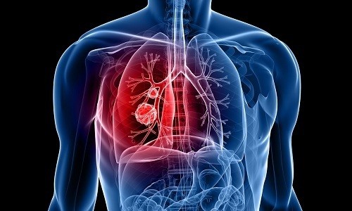 Одним из наиболее часто встречаемых заболеваний дыхательной системы является бронхит