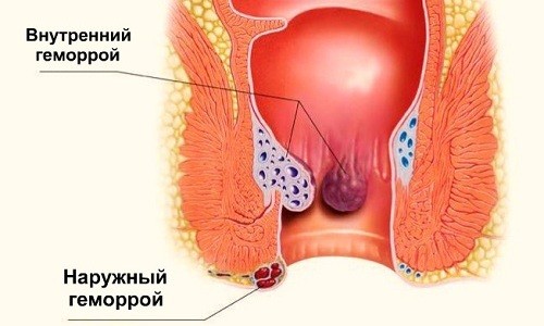 Прямым противопоказанием к применению алоэ является геморрой