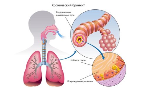 Хронический бронхит чаще встречается у взрослых и возникает из-за неправильного лечения острого бронхита