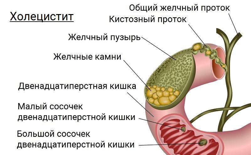 Острый холецистит