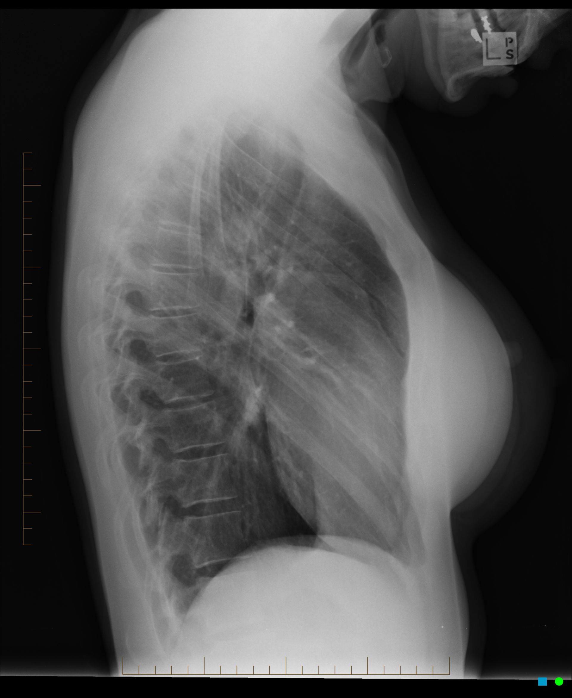 Легкие груди. Рентген грудной клетки сбоку. Рентген грудины.