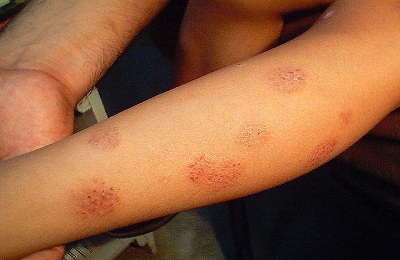 discoid-eczema-treatment