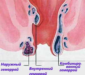 Типы геморроидальных узлов