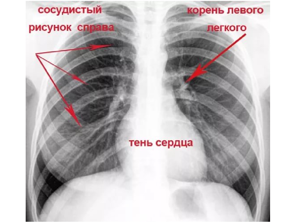 Справа было видно. Рентген легких. Лёгкие здорового человека флюорография. Снимки легких здорового человека флюорография.