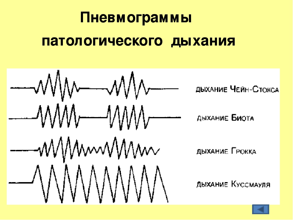 Патологическое дыхание. Типы дыхания Куссмауля Чейна Стокса Биота. Дыхание Куссмауля Биота Чейна. Дыхание Биота Чейна Стокса Грокка. Патологические типы дыхания Биота.