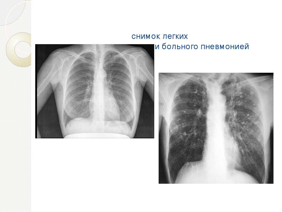 Легкие человека снимок. Легкие здорового человека рентген и пневмония. Рентген легких здорового человека и с пневмонией. Рентген легких здорового человека и больного пневмонией. Рентген снимок лёгких здорового человека.