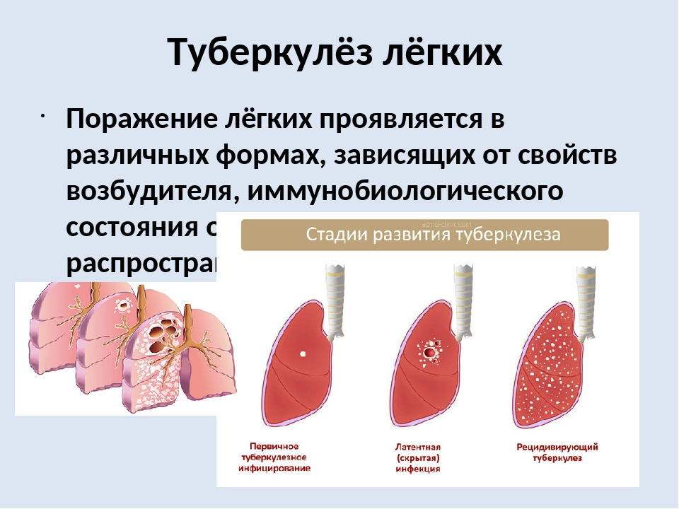 Туберкулез стадии симптомы. Стадии туберкулезного процесса легких. Стадии развития туберкулеза легких. Садии развития туберкулёза. Этапы развития туберкулёза лёгких.