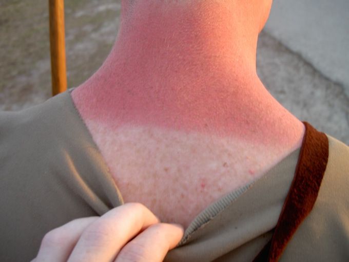 sunburnt neck