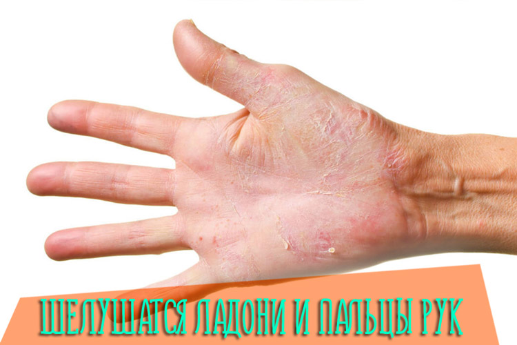 Шелушатся ладони и пальцы рук, причины и лечение кожи