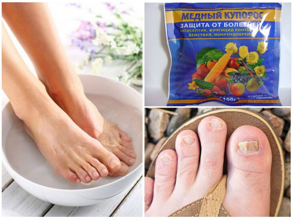 Чем можно вылечить грибок на ногах. Ванночки для ног от грибка на ногтях. Грибок ногтей на подошве ног.