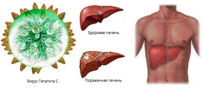 Вирусный гепатит печени. Эпидемический гепатит Боткина. Вирусный гепатит б.