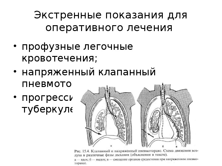 Спонтанный пневмоторакс