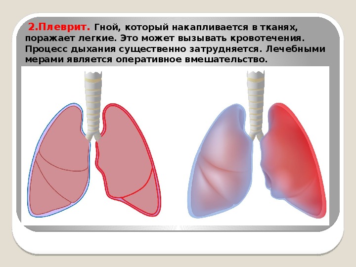 Плеврит легких что. Профилактика плеврита легких.